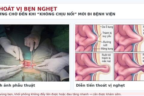 Thoát vị bẹn nghẹt - đừng chờ đến khi không chịu nổi mới đi Bệnh viện